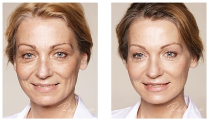 injectables women